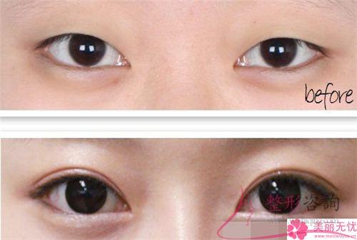 韓式<a href=http://m.f3bb6.cn/listinfo-724-0.html target=_blank class=infotextkey>雙眼皮</a>法是埋線<a href=http://m.f3bb6.cn/listinfo-724-0.html target=_blank class=infotextkey>雙眼皮</a>法嗎?是可以保持多長時(shí)間