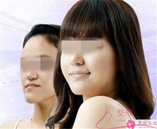 <a href=http://m.f3bb6.cn/listinfo-629-0.html target=_blank class=infotextkey>下頜角</a>整形手術哪一個手術方法<a href=http://m.f3bb6.cn/listinfo-631-0.html target=_blank class=infotextkey>瘦臉</a>效果好