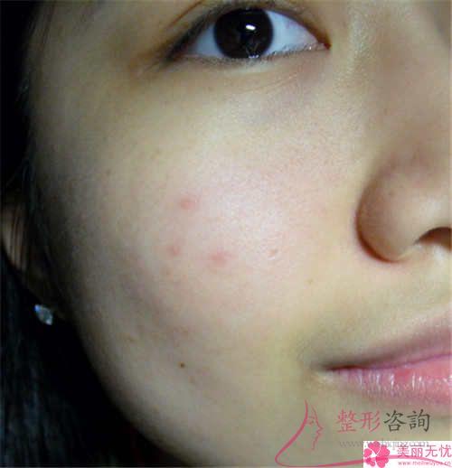 外眼角切開術的含義？有留疤痕的危害嗎？