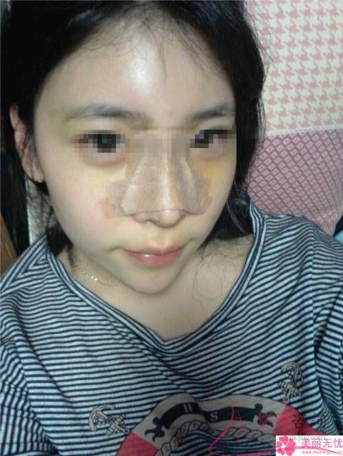 打微晶瓷<a href=http://m.f3bb6.cn/listinfo-737-0.html target=_blank class=infotextkey>隆鼻</a>的注意事項有哪些