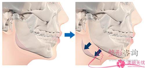 <a href=http://m.f3bb6.cn/listinfo-629-0.html target=_blank class=infotextkey>下頜角</a>磨骨有并發(fā)癥嗎？有哪些副作用？