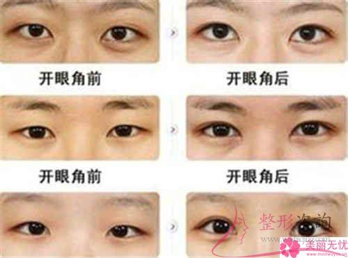 不同的6大<a href=http://m.f3bb6.cn/listinfo-711-0.html target=_blank class=infotextkey>開眼角</a>手術的優點