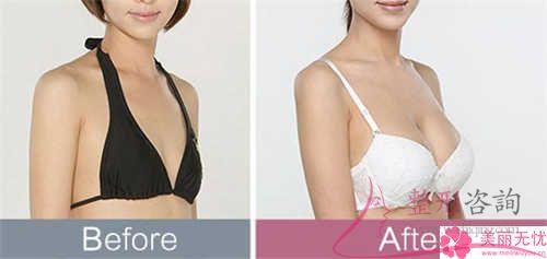 妙桃假體<a href=http://m.f3bb6.cn/listinfo-618-0.html target=_blank class=infotextkey>隆胸</a>以后啥子原因會(huì)引發(fā)乳房表層麻木感？