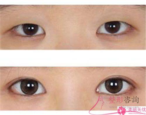 <a href=http://m.f3bb6.cn/listinfo-711-0.html target=_blank class=infotextkey>開眼角</a>以后傷口痊愈速度怎么樣