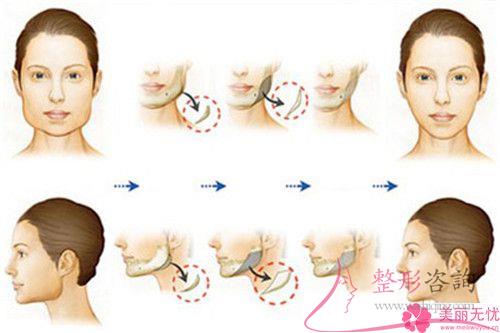 手術方法進行面部縮緊對皮膚破壞大不大