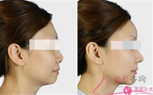 肉毒桿菌針劑得以去掉額頭紋嗎