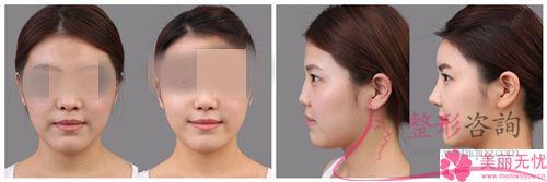 膨體聚四氟乙烯<a href=http://m.f3bb6.cn/listinfo-737-0.html target=_blank class=infotextkey>隆鼻</a>術安全嗎？能否細菌感染？