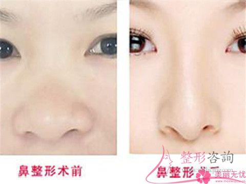 過大的<a href=http://m.f3bb6.cn/listinfo-754-0.html target=_blank class=infotextkey>鼻翼</a>是需如何矯正