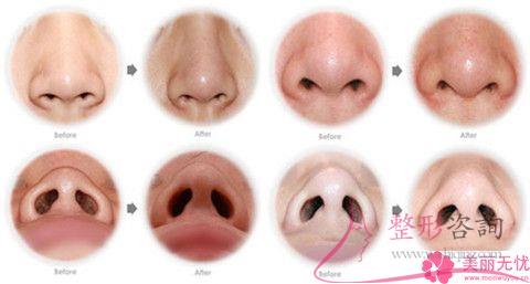 過大的<a href=http://m.f3bb6.cn/listinfo-754-0.html target=_blank class=infotextkey>鼻翼</a>是需如何矯正