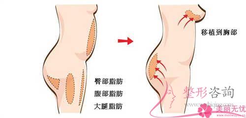 雅靚假體<a href=http://m.f3bb6.cn/listinfo-618-0.html target=_blank class=infotextkey>隆胸</a>手術過后哪些事項可幫助各位增加康復？多長時間可以愈合？