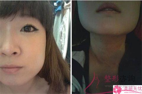 顴骨削骨術需要注意哪些事項