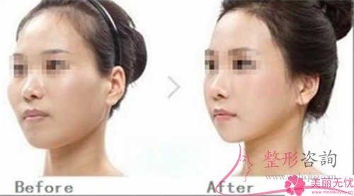 顴骨削骨術需要注意哪些事項