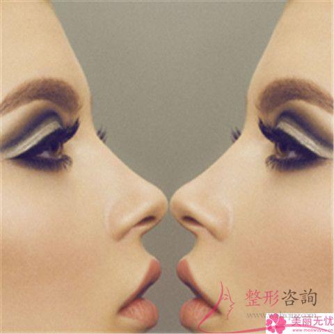 做縮小<a href=http://m.f3bb6.cn/listinfo-754-0.html target=_blank class=infotextkey>鼻翼</a>的價格如何收費