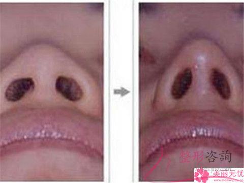 做鼻頭<a href=http://m.f3bb6.cn/listinfo-754-0.html target=_blank class=infotextkey>鼻翼</a>縮小價(jià)格怎么定位