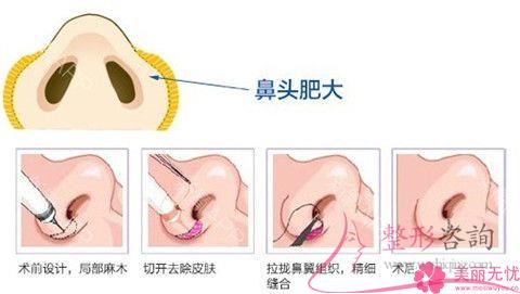 做<a href=http://m.f3bb6.cn/listinfo-754-0.html target=_blank class=infotextkey>鼻翼</a>整形術價格介紹