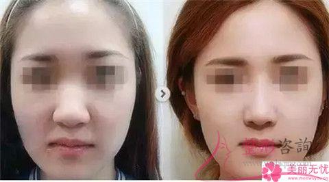 做<a href=http://m.f3bb6.cn/listinfo-754-0.html target=_blank class=infotextkey>鼻翼</a>縮小術價格范圍是多少