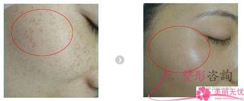 醫美<a href=http://m.f3bb6.cn/listinfo-795-0.html target=_blank class=infotextkey>祛斑</a>期間如果臉上特別紅正常嗎