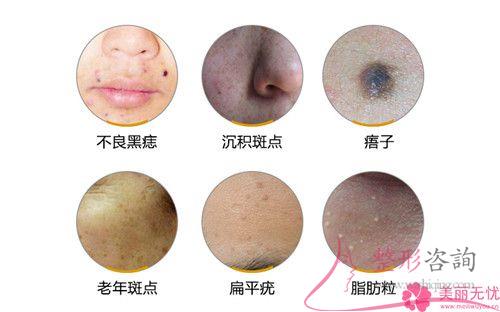 醫美<a href=http://m.f3bb6.cn/listinfo-795-0.html target=_blank class=infotextkey>祛斑</a>期間如果臉上特別紅正常嗎