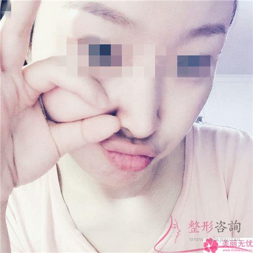 填充蘋果肌后出現(xiàn)移位的概率大不大