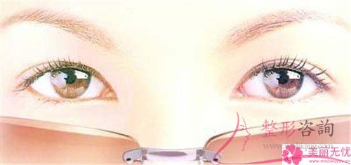 上瞼提肌縮短術(shù)的手術(shù)費用一般是8237元嗎