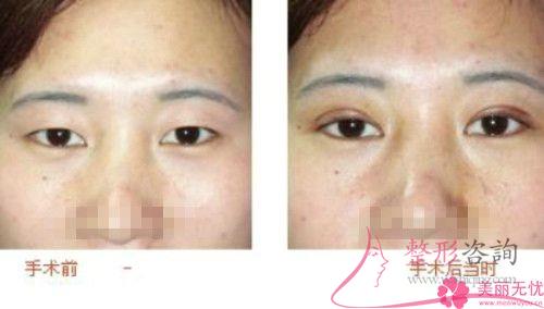 上瞼提肌縮短術(shù)的手術(shù)費用一般是8237元嗎