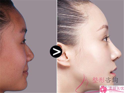 假體<a href=http://m.f3bb6.cn/listinfo-737-0.html target=_blank class=infotextkey>隆鼻</a>術(shù)效果若何體現(xiàn)