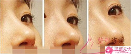 假體<a href=http://m.f3bb6.cn/listinfo-737-0.html target=_blank class=infotextkey>隆鼻</a>術(shù)效果若何體現(xiàn)