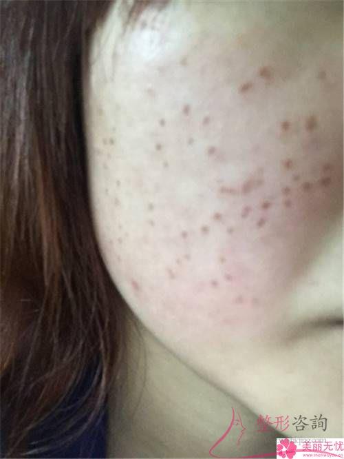 光動力祛痘需花幾個療效?去痘價格會很貴嗎?