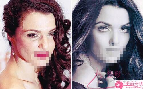 冰電波<a href=http://m.f3bb6.cn/listinfo-614-0.html target=_blank class=infotextkey>除皺</a>整形手術有哪3種特點？治療一次好多元？