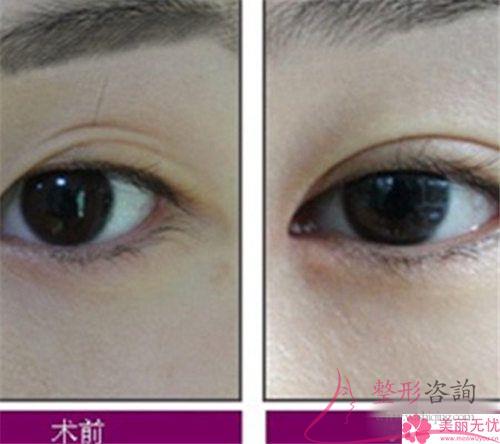 割<a href=http://m.f3bb6.cn/listinfo-724-0.html target=_blank class=infotextkey>雙眼皮</a>手術不理想情況有些什么