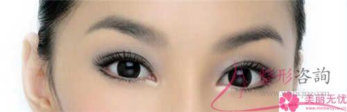 割<a href=http://m.f3bb6.cn/listinfo-724-0.html target=_blank class=infotextkey>雙眼皮</a>手術不理想情況有些什么