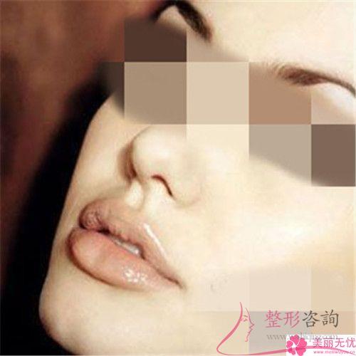 實施重唇修復手術有何手術風險嗎