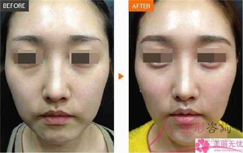 平常的<a href=http://m.f3bb6.cn/listinfo-614-0.html target=_blank class=infotextkey>除皺</a>抗衰成效,鋸齒線懸掛去皺方式能不能達到