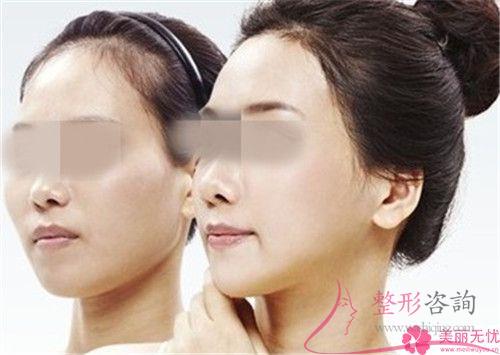 手術方法進行面部提拉對皮膚損害嚴不嚴重