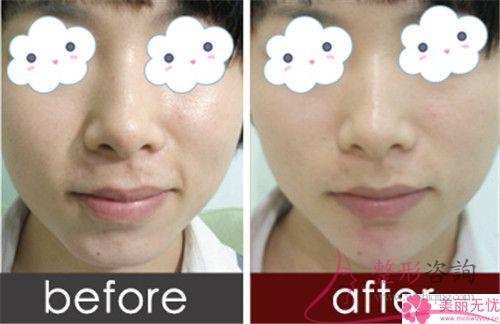 注入水動力<a href=http://m.f3bb6.cn/listinfo-682-0.html target=_blank class=infotextkey>溶脂</a><a href=http://m.f3bb6.cn/listinfo-631-0.html target=_blank class=infotextkey>瘦臉</a>對身子會有影響嗎