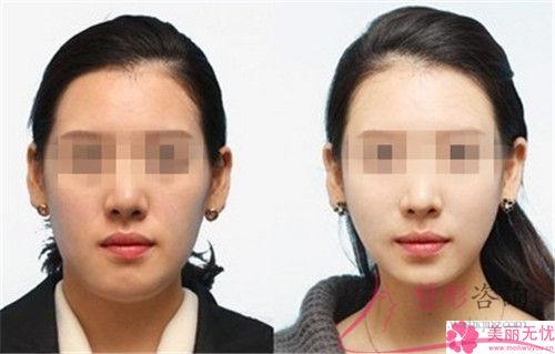 注入<a href=http://m.f3bb6.cn/listinfo-682-0.html target=_blank class=infotextkey>溶脂</a><a href=http://m.f3bb6.cn/listinfo-631-0.html target=_blank class=infotextkey>瘦臉</a>針多長會看到效果