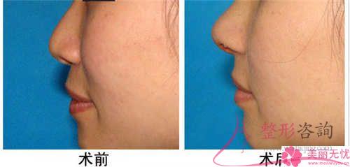 注射奧美定<a href=http://m.f3bb6.cn/listinfo-737-0.html target=_blank class=infotextkey>隆鼻</a>好多錢一回