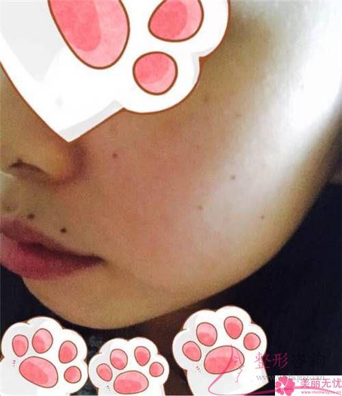 激光去咖啡斑手術只滿足身體健康便能嗎？