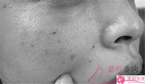 激光祛咖啡斑手術前提因素有哪一些？