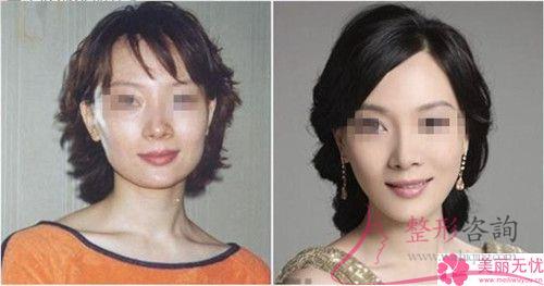 矯正塌鼻子有傷害嗎？有何傷害