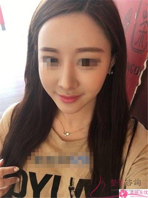 空鼻手術治療效果怎么