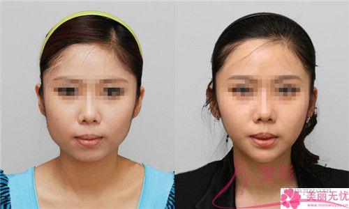 臉部<a href=http://m.f3bb6.cn/listinfo-682-0.html target=_blank class=infotextkey>溶脂</a>見效有那么好嗎