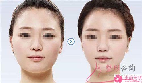 臉部<a href=http://m.f3bb6.cn/listinfo-682-0.html target=_blank class=infotextkey>溶脂</a>見效有那么好嗎