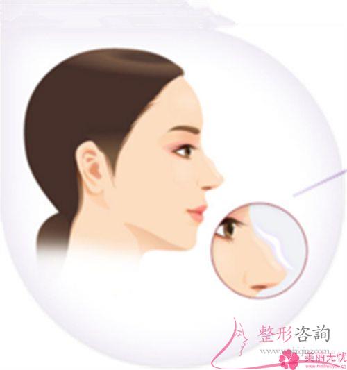 膨體聚四氟乙烯<a href=http://m.f3bb6.cn/listinfo-737-0.html target=_blank class=infotextkey>隆鼻</a>術靠譜嗎？是否有造成感染？