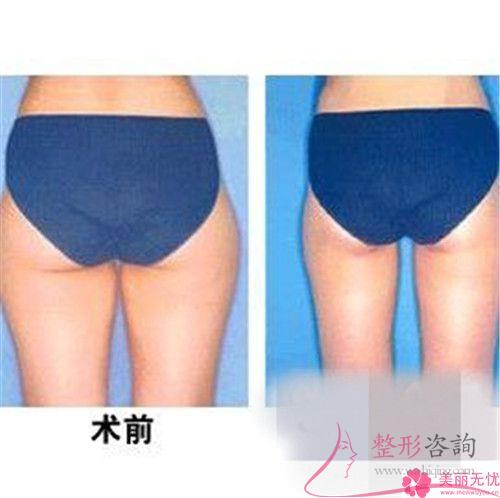 自體組織<a href=http://m.f3bb6.cn/listinfo-677-0.html target=_blank class=infotextkey>豐臀</a>的四大長處