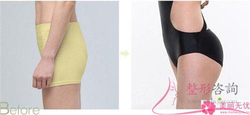 自體組織<a href=http://m.f3bb6.cn/listinfo-677-0.html target=_blank class=infotextkey>豐臀</a>維系的時間長不長