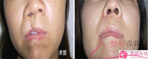 蒜頭鼻醫療整形可以變更我們的鼻子什么后遺癥