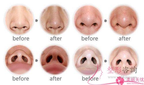 蒜頭鼻醫療整形可以變更我們的鼻子什么后遺癥