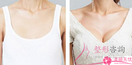 雪藍貝假體<a href=http://m.f3bb6.cn/listinfo-618-0.html target=_blank class=infotextkey>隆胸</a>需要好多錢？效果到底好不好？