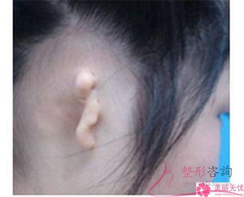 <a href=http://m.f3bb6.cn/listinfo-698-0.html target=_blank class=infotextkey>招風耳矯正</a>手術可以使用免拆除的縫線嗎